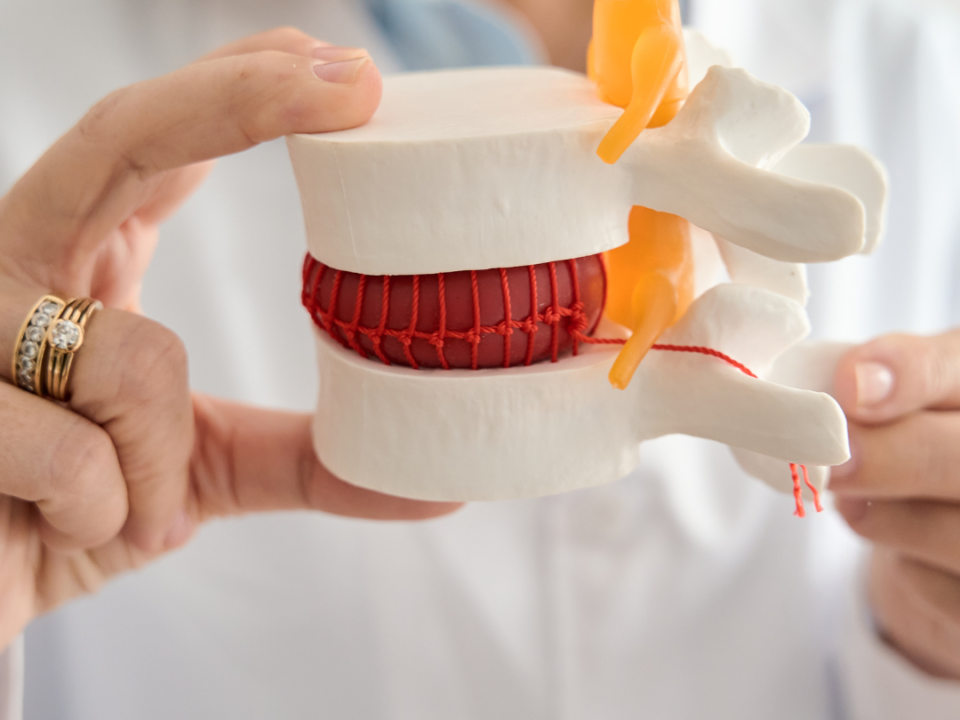 “Hernia de disco cuándo necesita cirugía"