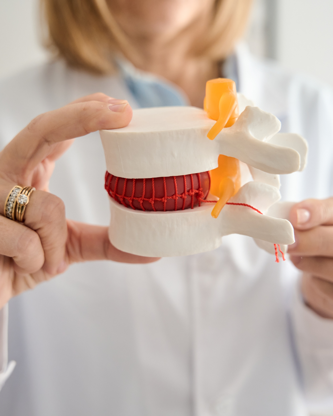 “Hernia de disco cuándo necesita cirugía"