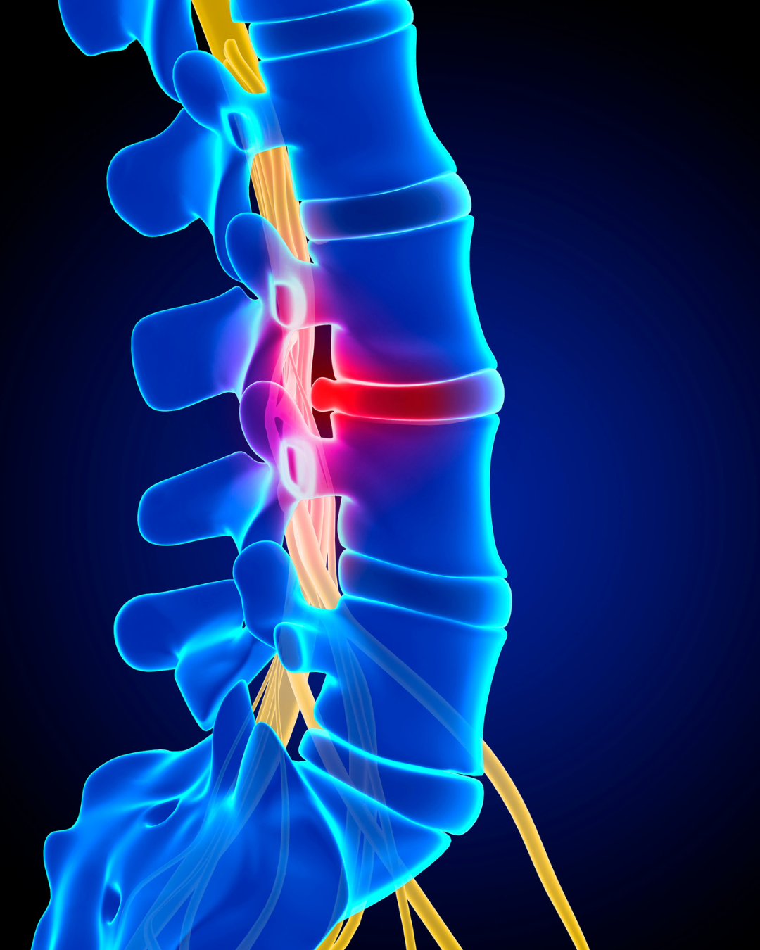cirugia de protesis de disco