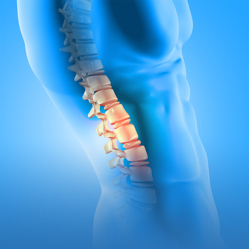 tratamiento de hernia de disco