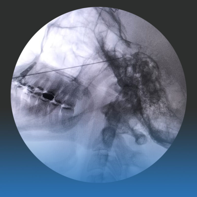 tratamiento de neuralgia de trigémino