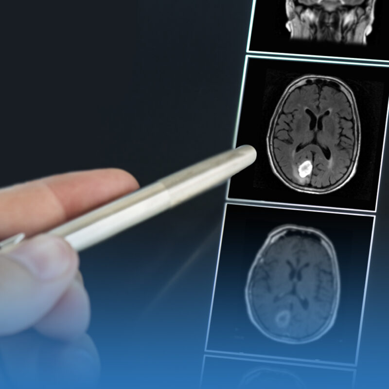 tratamiento de tumores cerebrales