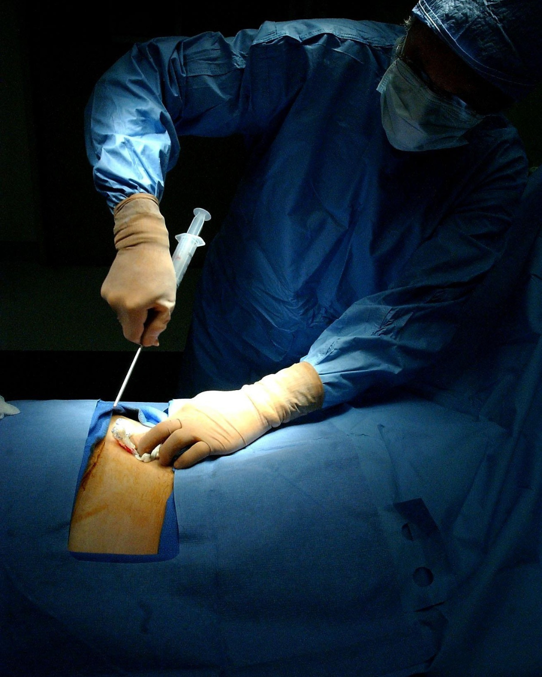 Especialista en hernia de disco CDMX